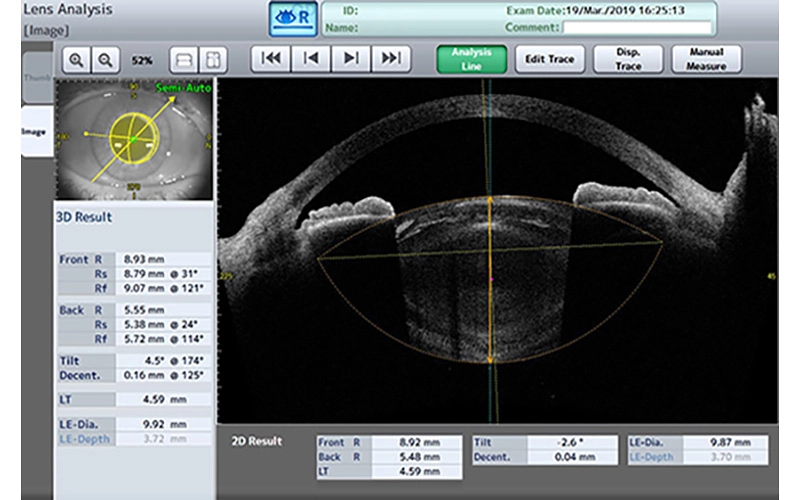 Cataract Lens Analysis