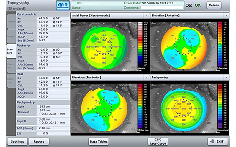 Cornea Topography
